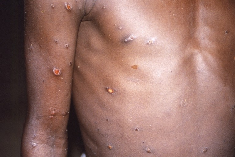 Monkeypox Spreading In US: What You Should Know