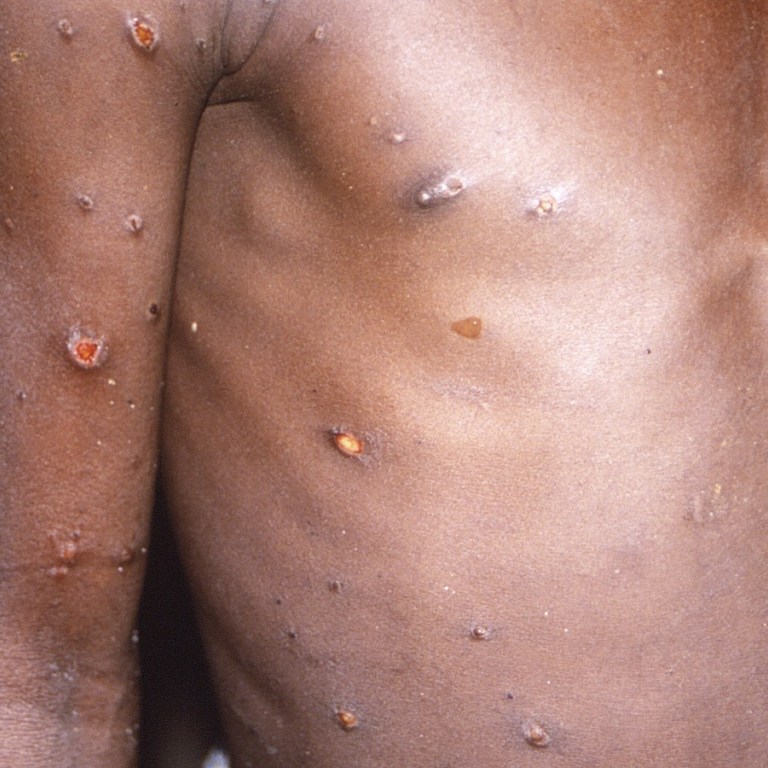 Monkeypox Spreading In US: What You Should Know